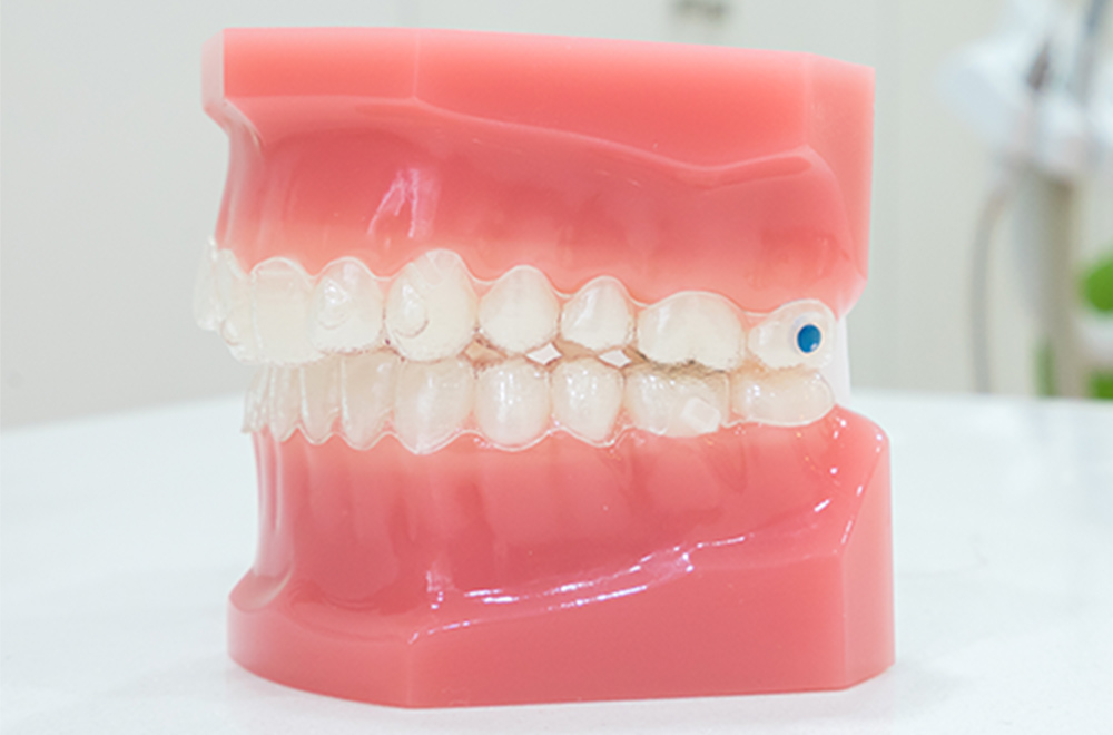抜歯ケースでは歯科矯正用アンカースクリュー（インプラント矯正）を使用