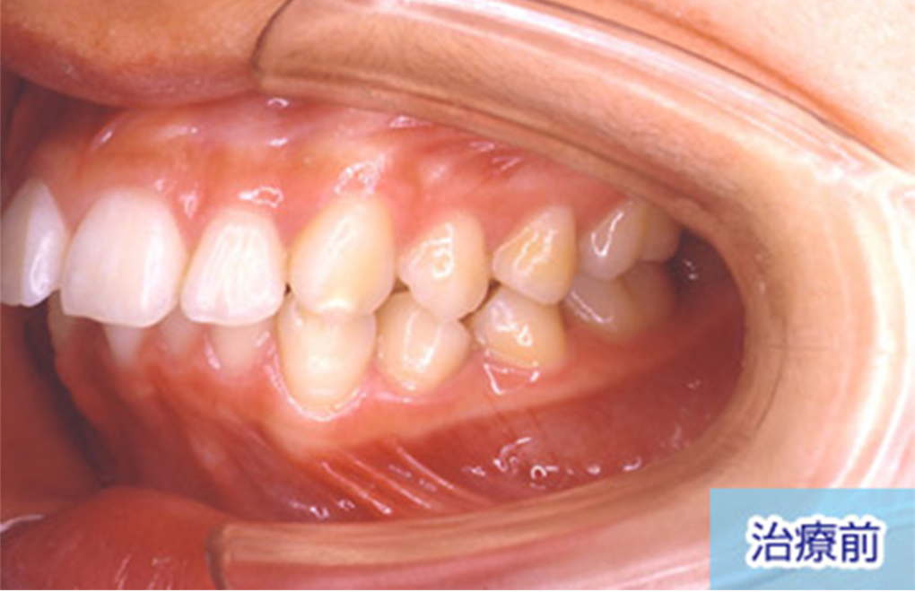 上顎前突（出っ歯） 治療前