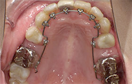 フルリンガル（上顎・下顎ともに裏側矯正）02