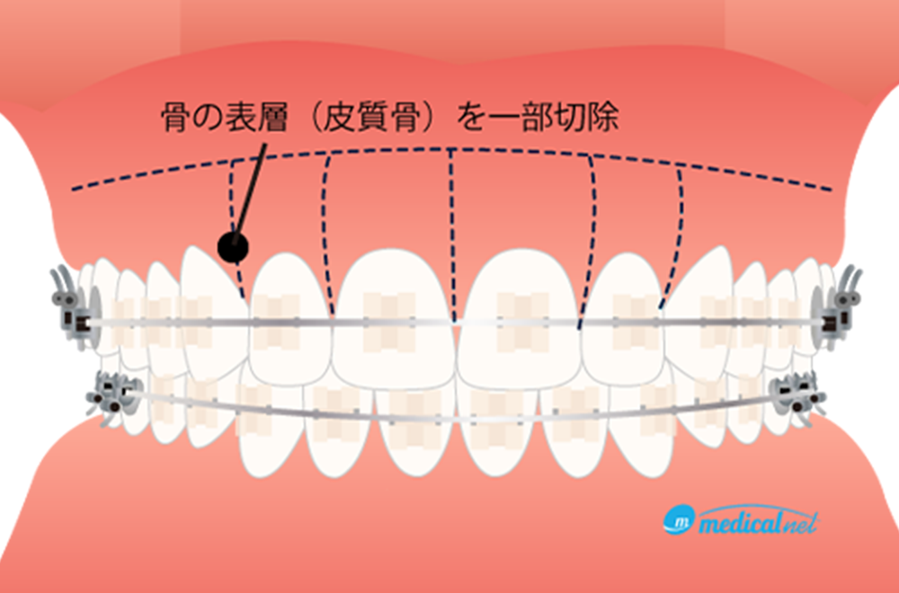 治療期間の短縮を図る「スピード矯正(コルチコトミー)」とは