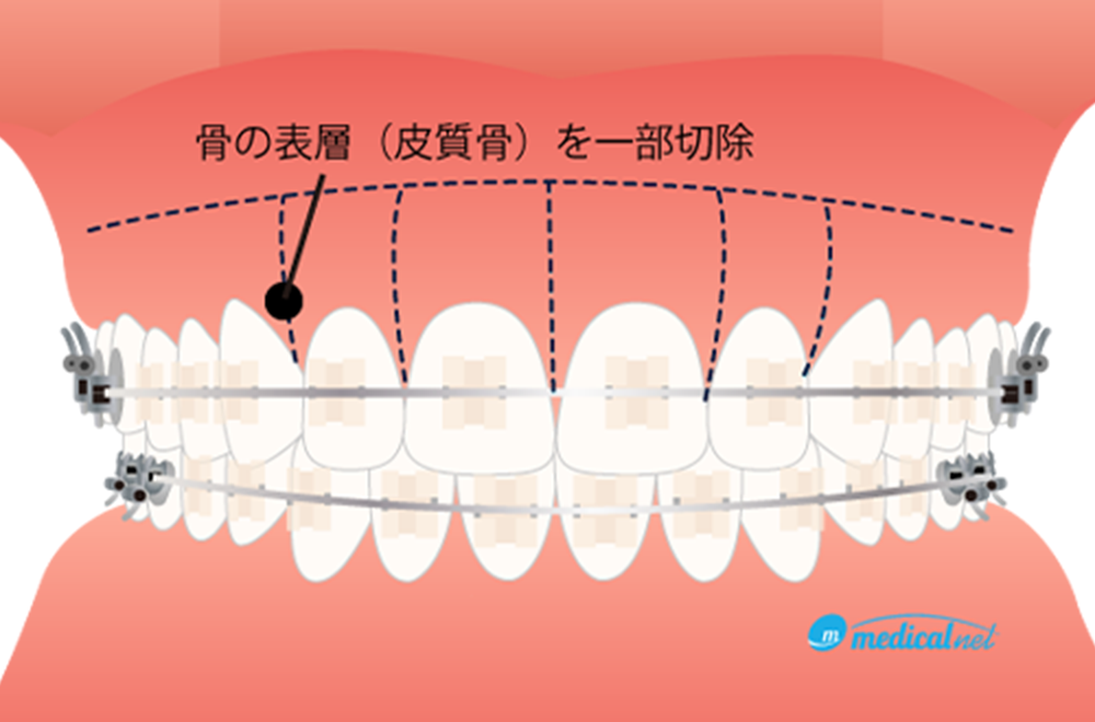 治療期間の短縮を図る「スピード矯正（コルチコトミー）」とは