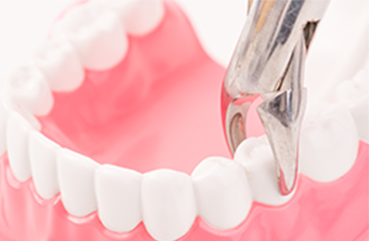 荒井矯正歯科クリニックでは抜歯の麻酔は次の3段階に分けて、痛みを抑えるように行なっています。