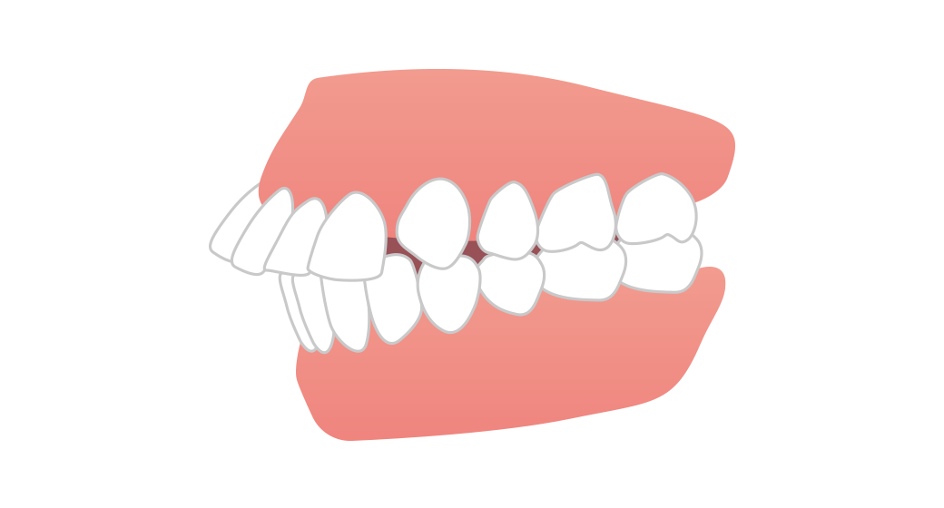 上顎前突（出っ歯）