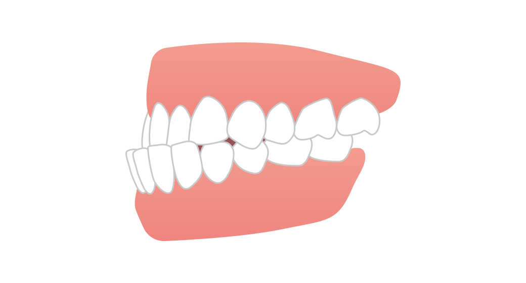 反対咬合（受け口）